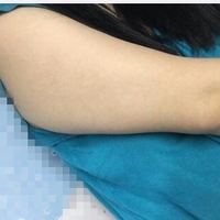 联合丽格整形医院可靠吗?******手臂吸脂案例及前后对比图与大家分享