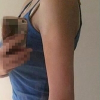 联合丽格整形医院可靠吗?******手臂吸脂案例及前后对比图与大家分享