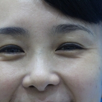 瑞兰玻尿酸注射除皱真实案例，教你如何“改头换面”