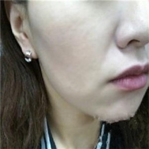 光波拉皮有果吗?光波拉皮恢复过程展示，附前后对比图