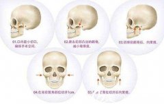 削骨要多少钱?北京张笑天自身经验为你解答 width=
