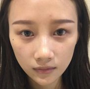 张冰洁的双眼皮修复案例：双眼皮失败后，我的悲痛人生! width=