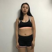 等离子光纤溶脂瘦身案例：打破肥胖魔咒喜提小蛮腰大长腿~ width=