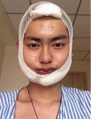 男士下颌角整形对比图，谁说整形是女人的专利