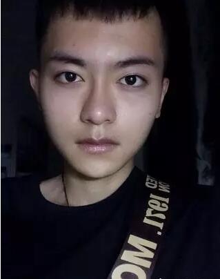 男士下颌角整形对比图，谁说整形是女人的专利
