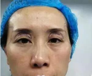 自体脂肪丰眼窝恢复期是多久?看我自体脂肪丰眼窝案例恢复全过程