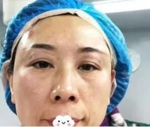 自体脂肪丰眼窝恢复期是多久?看我自体脂肪丰眼窝案例恢复全过程