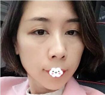自体脂肪丰眼窝恢复期是多久?看我自体脂肪丰眼窝案例恢复全过程