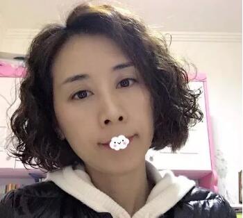 自体脂肪丰眼窝恢复期是多久?看我自体脂肪丰眼窝案例恢复全过程