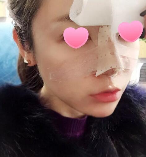 人工骨粉隆鼻