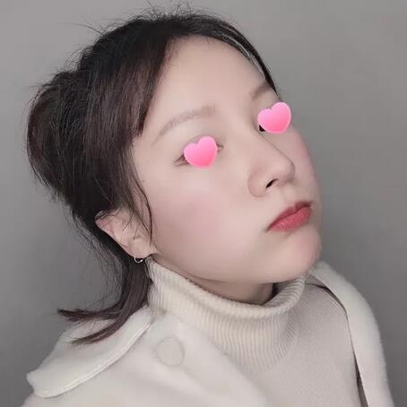 人工骨粉隆鼻