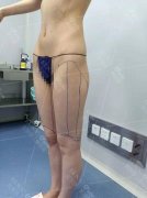 自体脂肪细胞丰胸真实案例：d罩杯有多大?大概这么大 width=