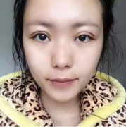 解永学吸雕双眼皮99天恢复经历，闲着没事就给大家分享一下我案例 width=