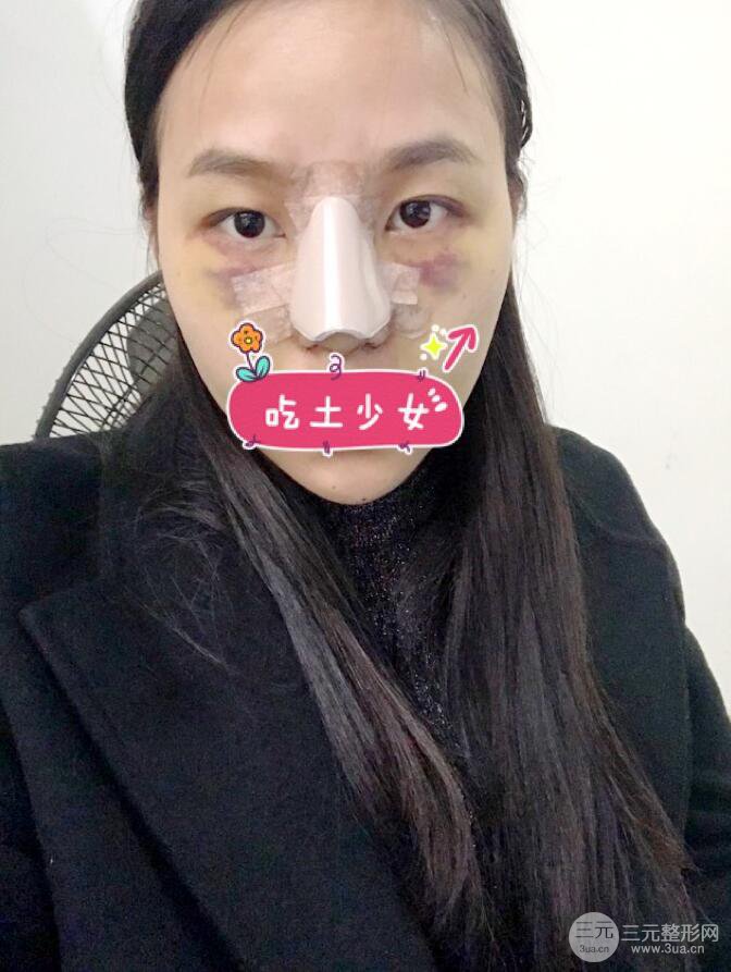 黄大勇医生隆鼻案例