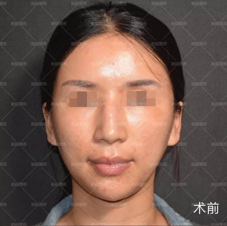 驼峰鼻多少钱喃？这则李劲良驼峰鼻矫正案例或许能告诉你！