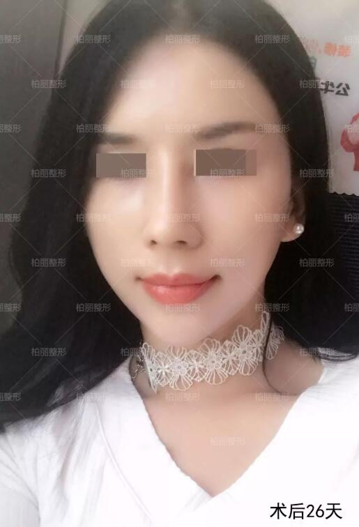 驼峰鼻多少钱喃？这则李劲良驼峰鼻矫正案例或许能告诉你！
