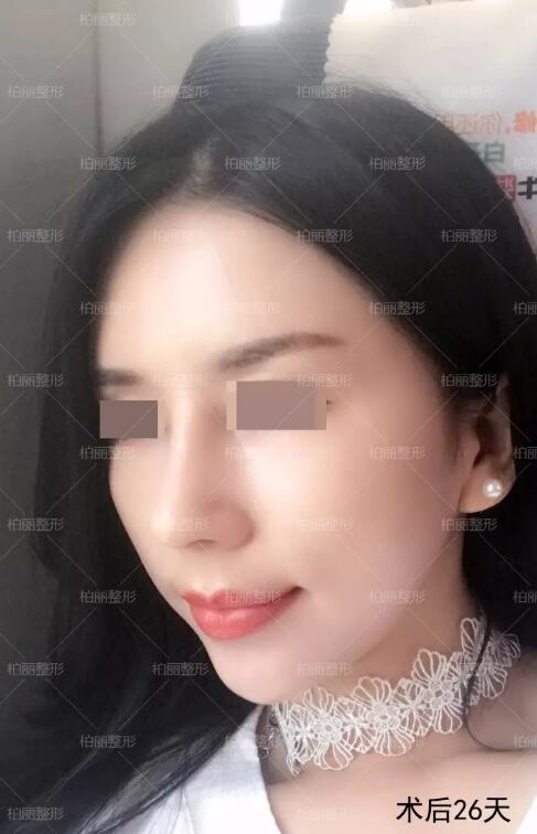 驼峰鼻多少钱喃？这则李劲良驼峰鼻矫正案例或许能告诉你！