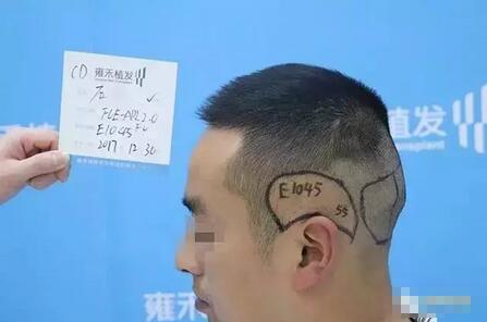 疤痕植发