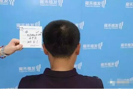 疤痕植发
