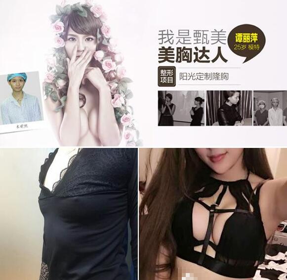 【菅秀梅准v自体脂肪技术怎么样|堪称丰胸界皇后】