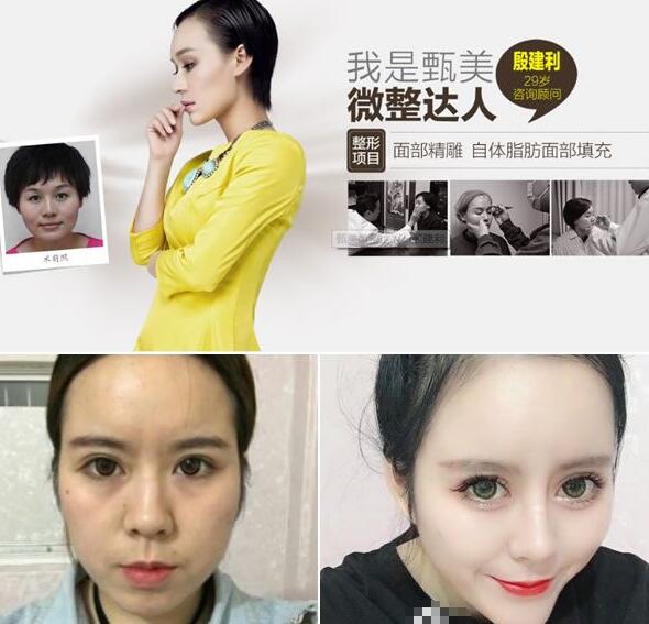【菅秀梅准v自体脂肪技术怎么样|堪称丰胸界皇后】