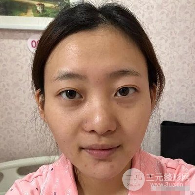 广州紫馨美容医院耳软骨垫鼻尖案例分享，来围观！