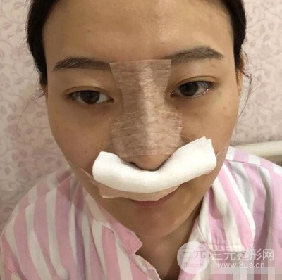 广州紫馨美容医院耳软骨垫鼻尖案例分享，来围观！