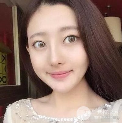 广州紫馨美容医院耳软骨垫鼻尖案例分享，来围观！