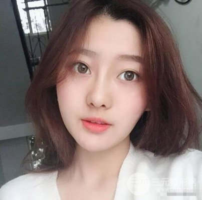 广州紫馨美容医院耳软骨垫鼻尖案例分享，来围观！