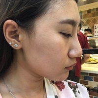 热玛吉紧肤果怎么样?我们用实际情况来说话