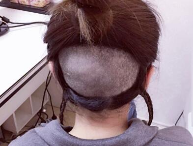 美人尖是什么样子的?来看看我的美人尖种植案例你就知道了