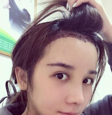 美人尖是什么样子的?来看看我的美人尖种植案例你就知道了