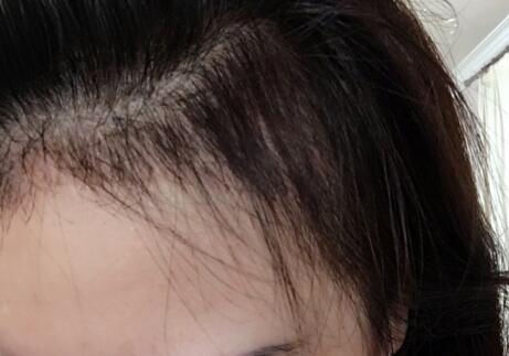 美人尖是什么样子的?来看看我的美人尖种植案例你就知道了