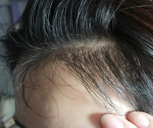 美人尖是什么样子的?来看看我的美人尖种植案例你就知道了