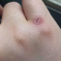 什么是疤痕体质皮肤?我用我的痛苦经历来为你解答