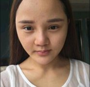 成都细致美妍做的鼻部手术手术，韩式小翘鼻成功get! width=