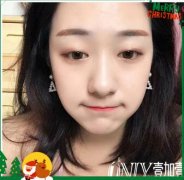 合肥壹加壹金鱼眼整形案例：从凸眼变成美少女~ width=