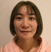 飞梭镭射去痘印案例分享：真实经历解析祛痘神器~ width=