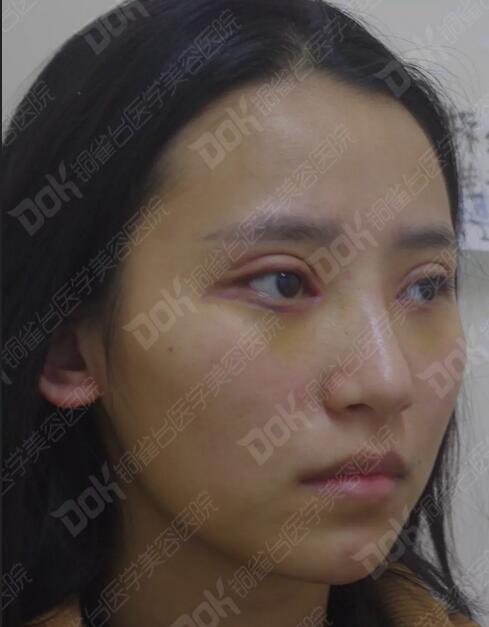 韩式翘睫双眼皮