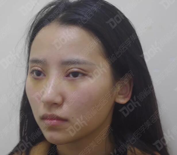 韩式翘睫双眼皮