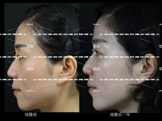 黄金埋线提升