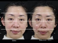 黄金埋线提升是什么？黄金埋线提升案例为你详解！ width=