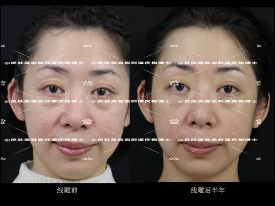 黄金埋线提升