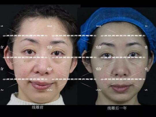 黄金埋线提升