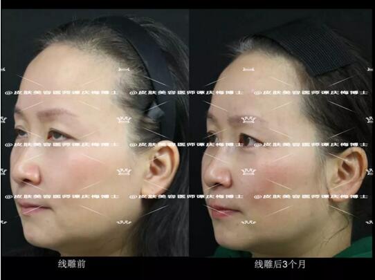黄金埋线提升