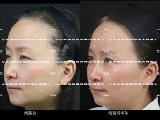 黄金埋线提升