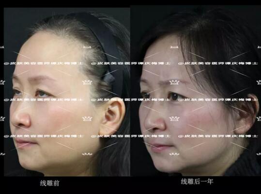 黄金埋线提升