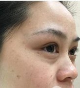 用我的亲身案例告诉你飞梭镭射祛斑除痘印是很好的选择方案~ width=