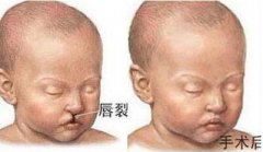 唇腭裂整形能做到吗?上海九院为你解答 width=