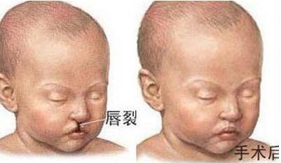 唇腭裂整形能做到吗?上海九院为你解答